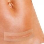 تجربتي مع لصقات السيليكون وكيفية استخدامها