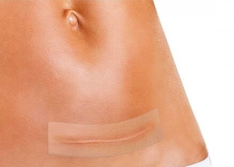 تجربتي مع لصقات السيليكون وكيفية استخدامها